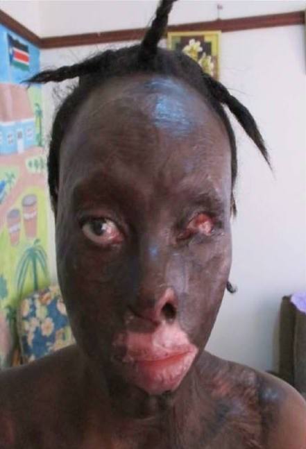 12219483_1158800447486828_7840630481395813065_n-2 Burn Survivor Before And After