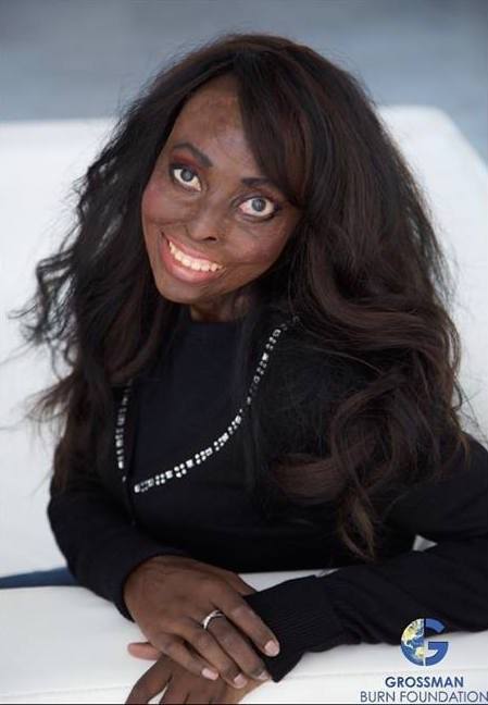 12219483_1158800447486828_7840630481395813065_n Burn Survivor Before And After