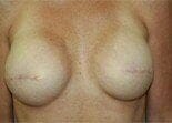 AREOLA PIGMENTATION before