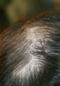 man hair scalp