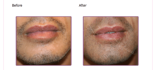 male lips before and after