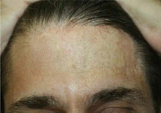 a Burn Survivor Before and After Photo