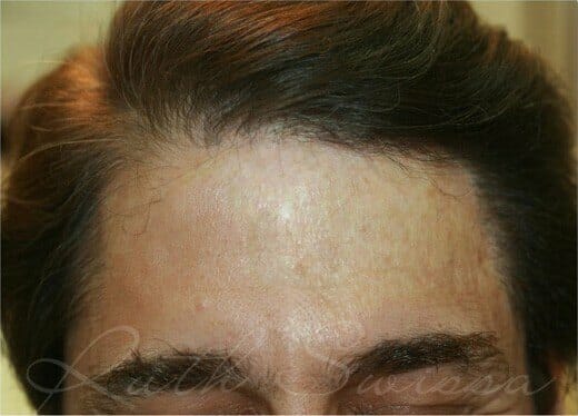 b Burn Survivor Before And After