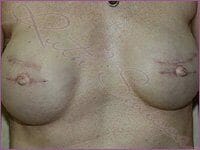 pigmentation areola