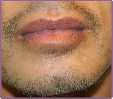 male lips and chin area