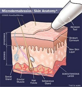 microdermab2-283x300