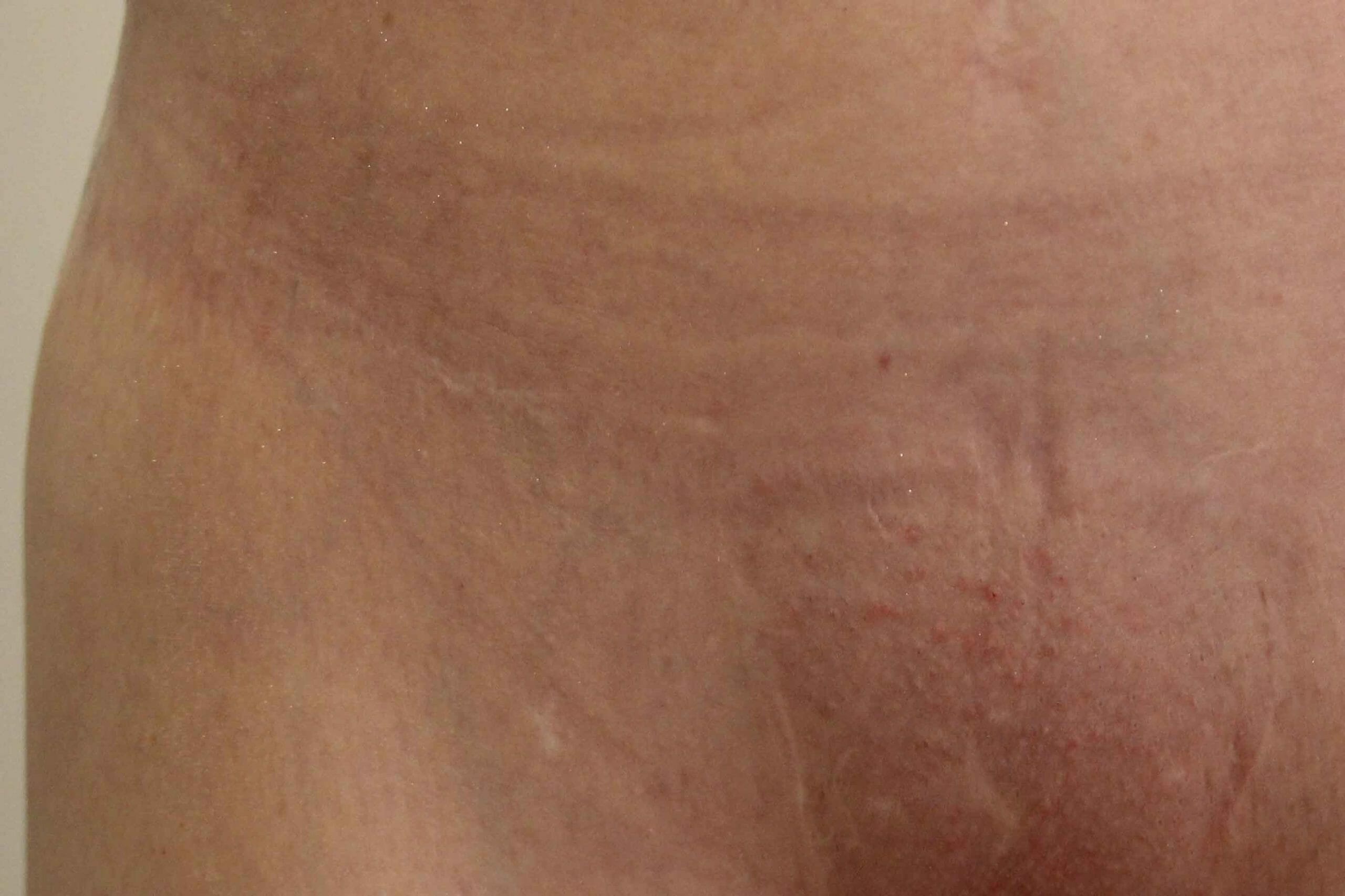 Scar Camouflage with Micropigmentation  Complete Guide