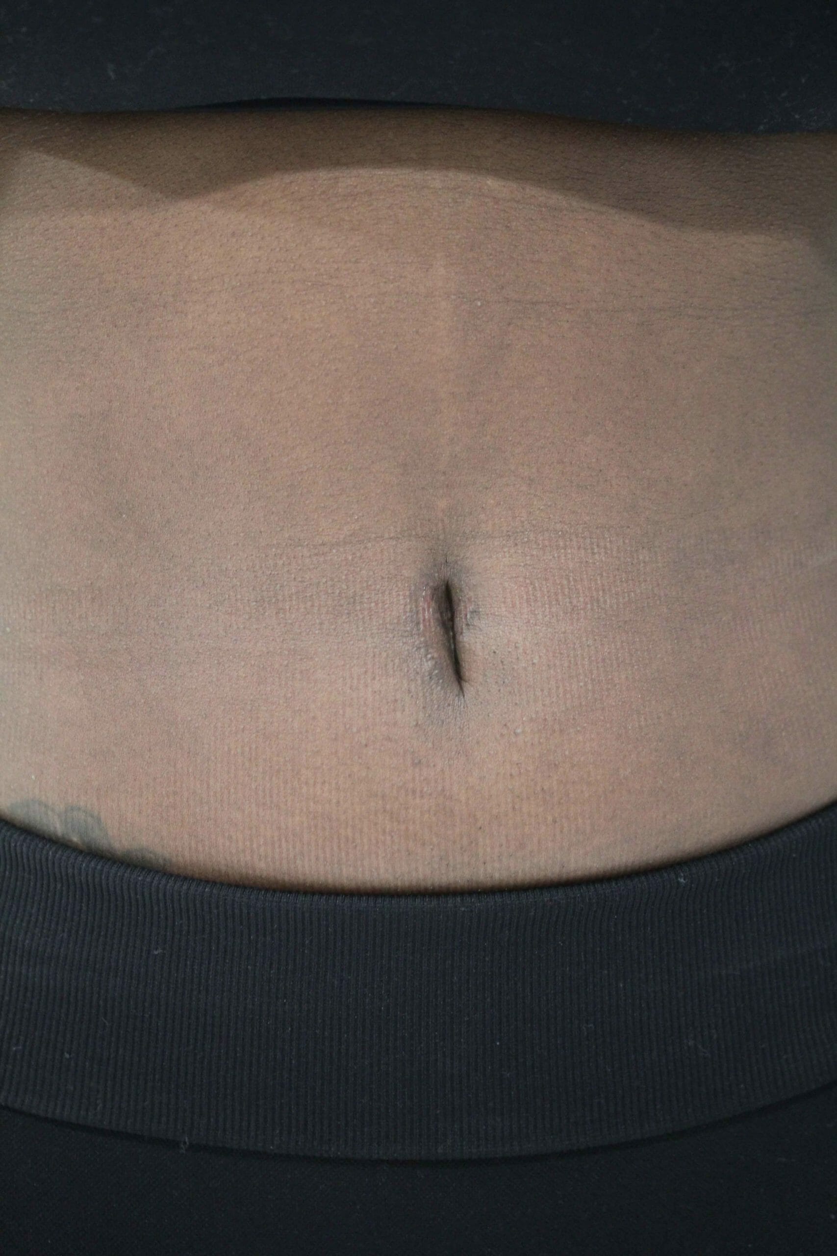 Before Scar Camouflage Treatment Photo
