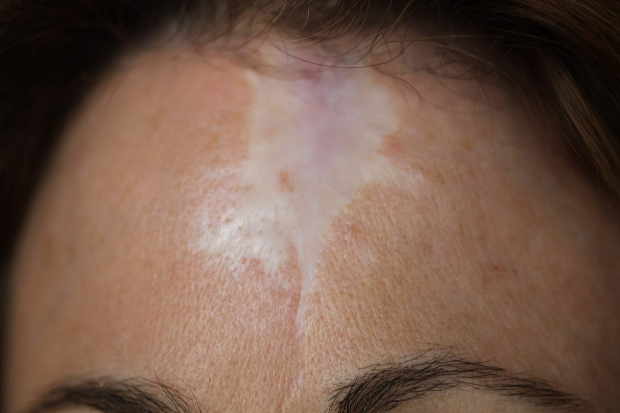 Scar Camouflage Treatments  Atlanta  Anna Burns Permanent Cosmetics