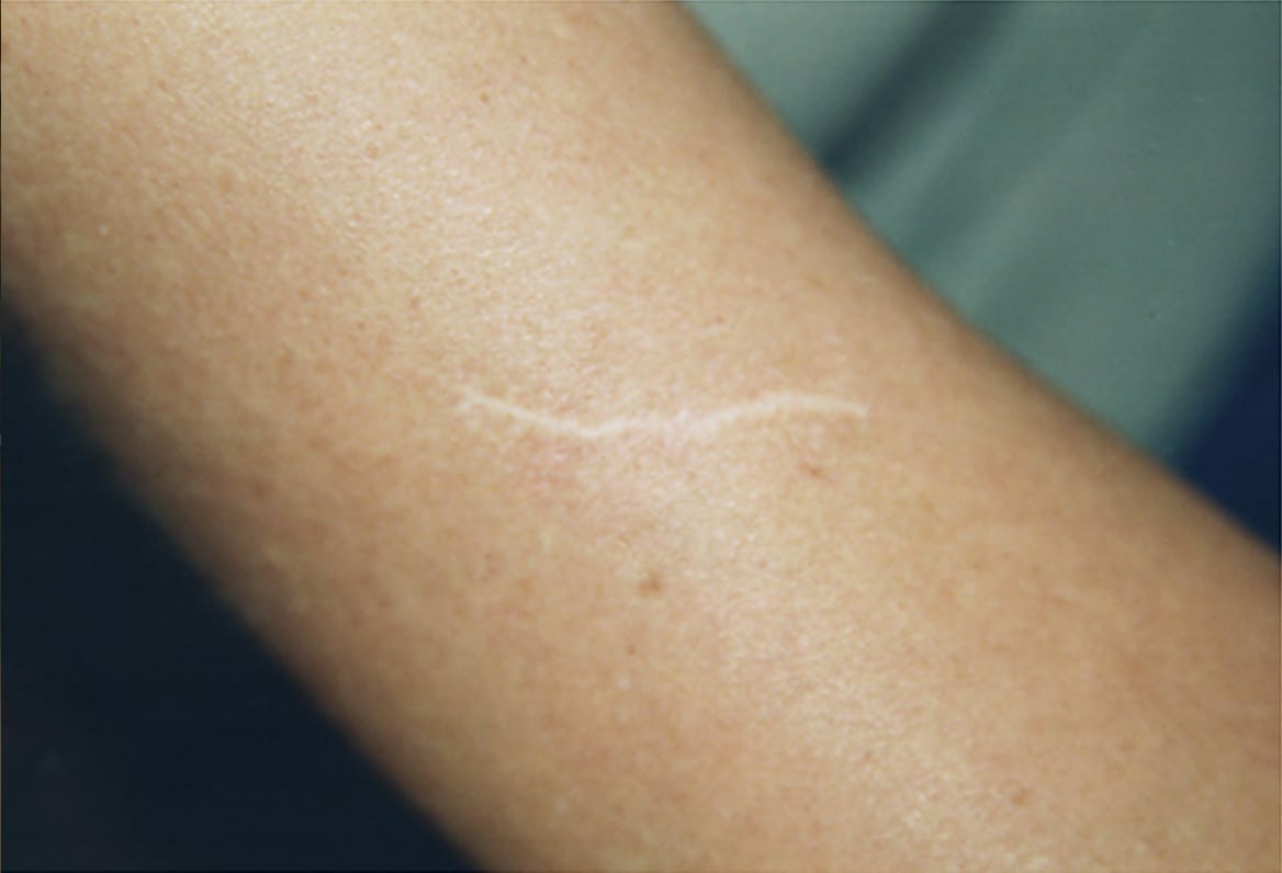 scar camouflage