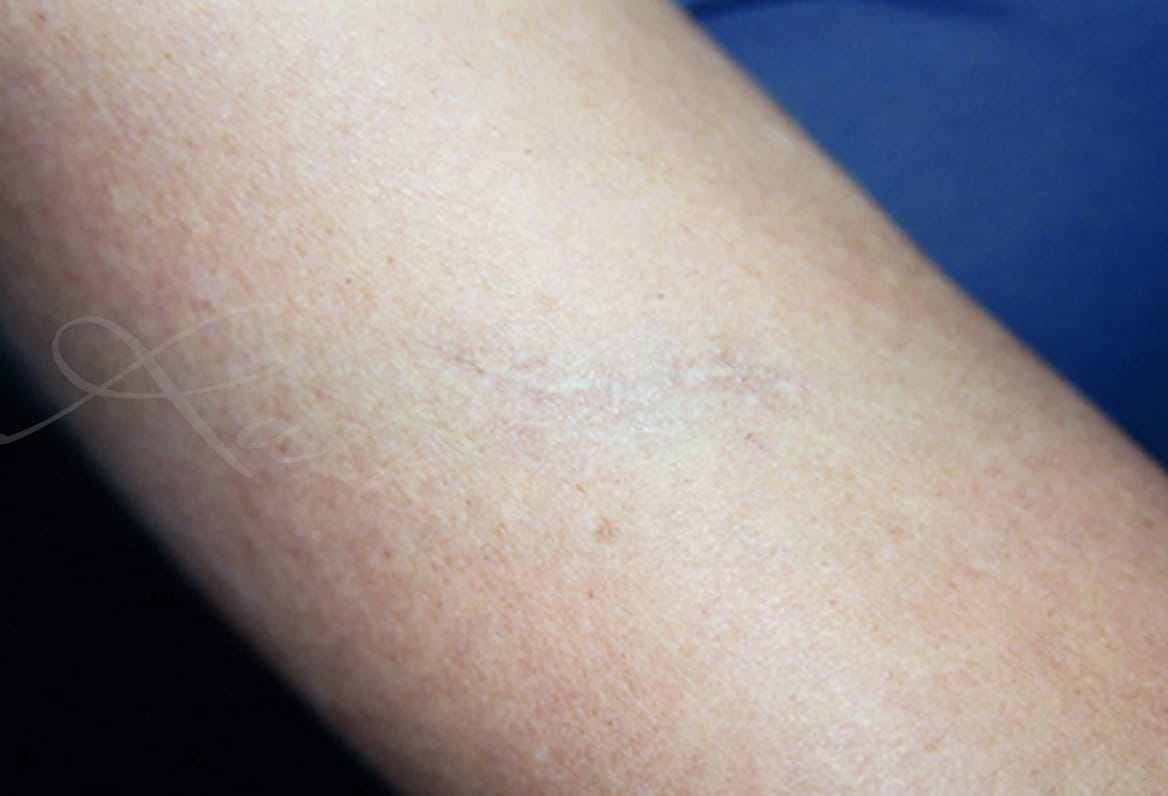 Scar Camouflage Before & After