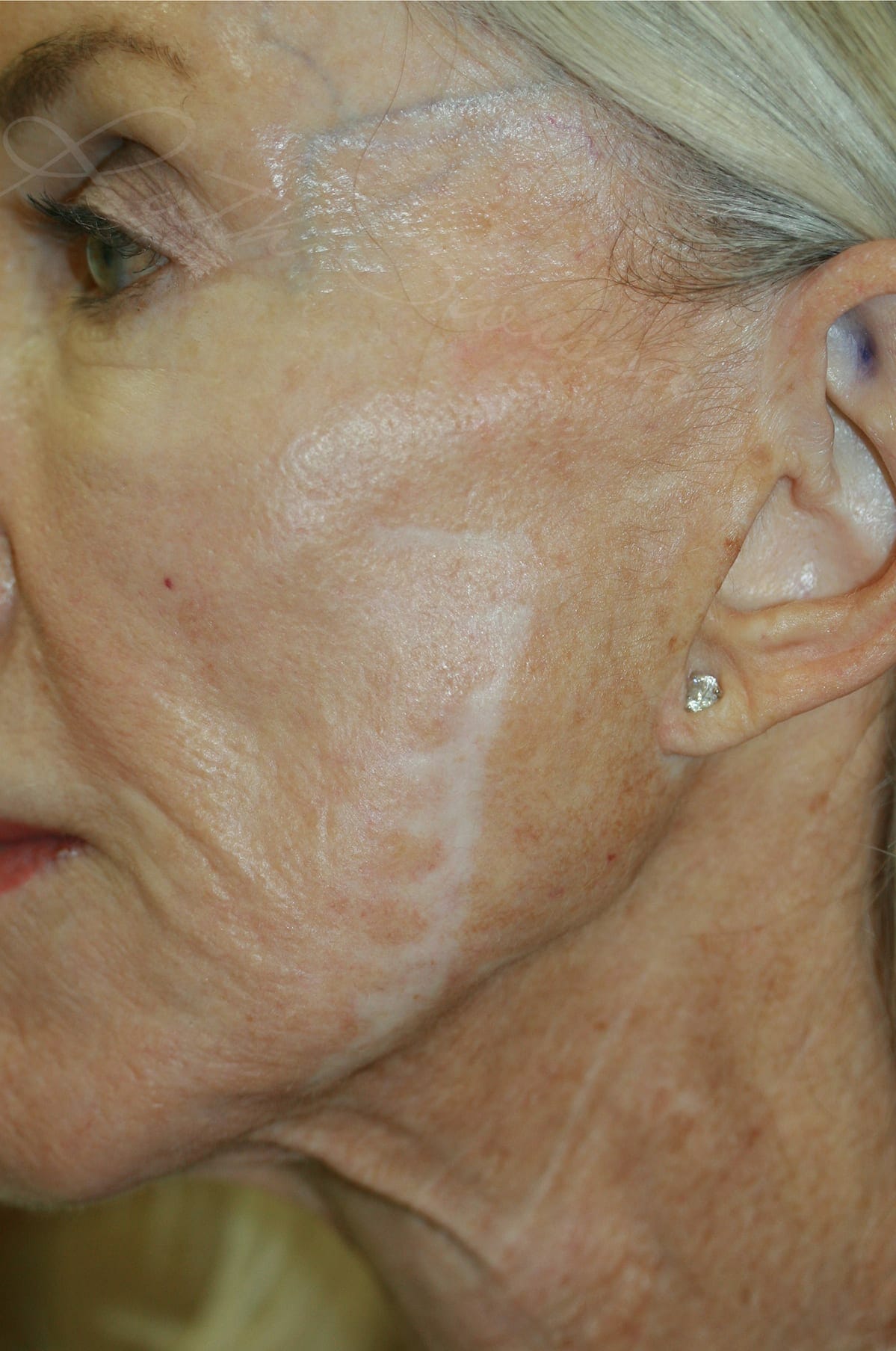 SKIN Scar Camouflage