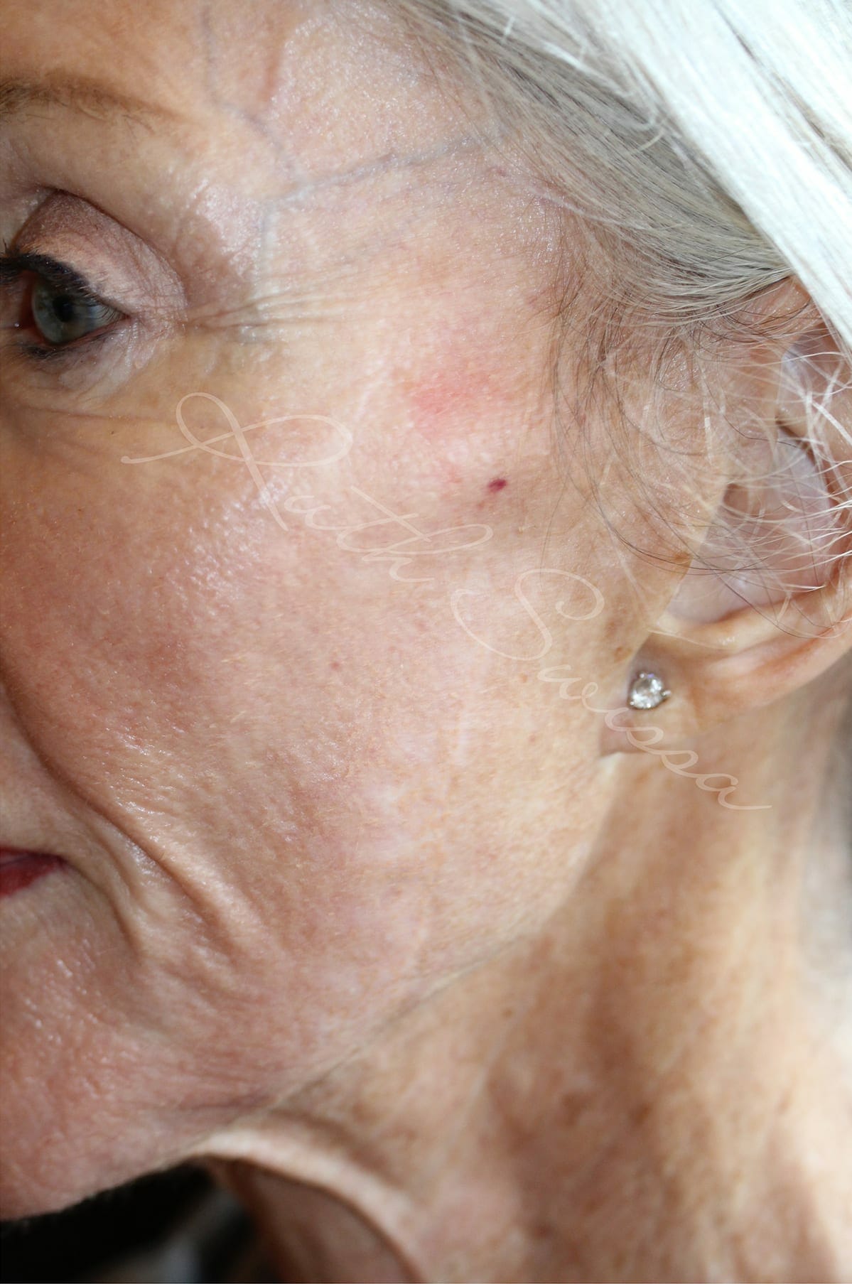 Permanent Makeup for Scar Camouflage