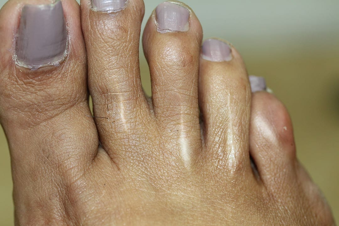 Toe Scar Camouflage