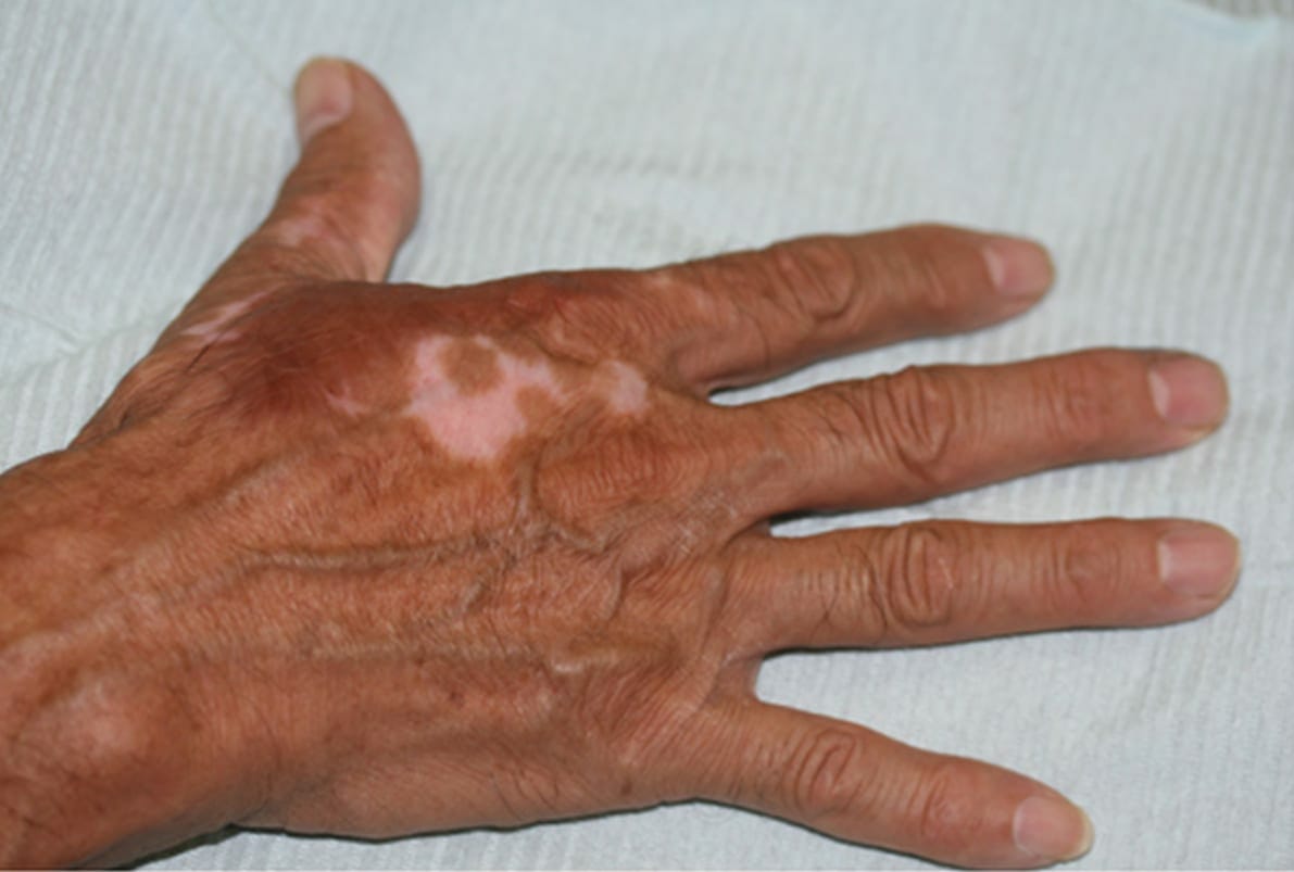 Permanent Makeup for Scar Camouflage