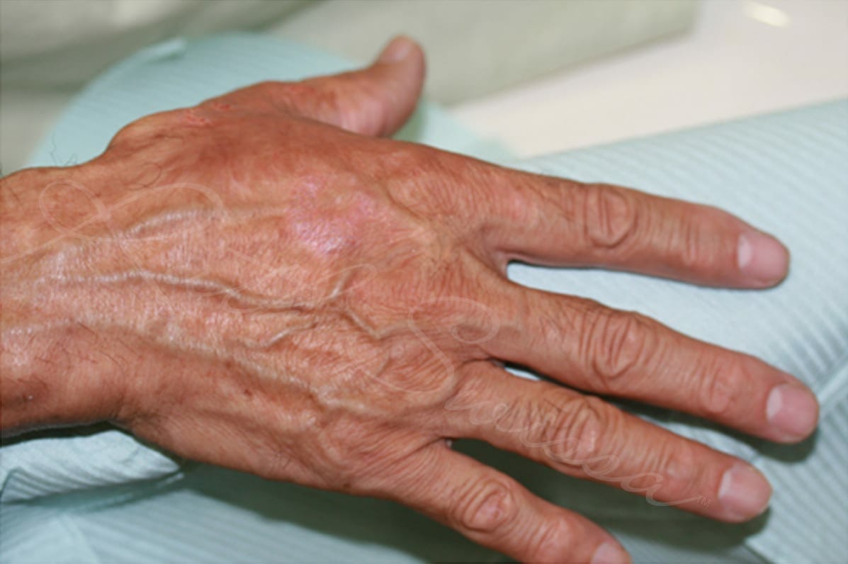 Permanent Makeup for Scar Camouflage