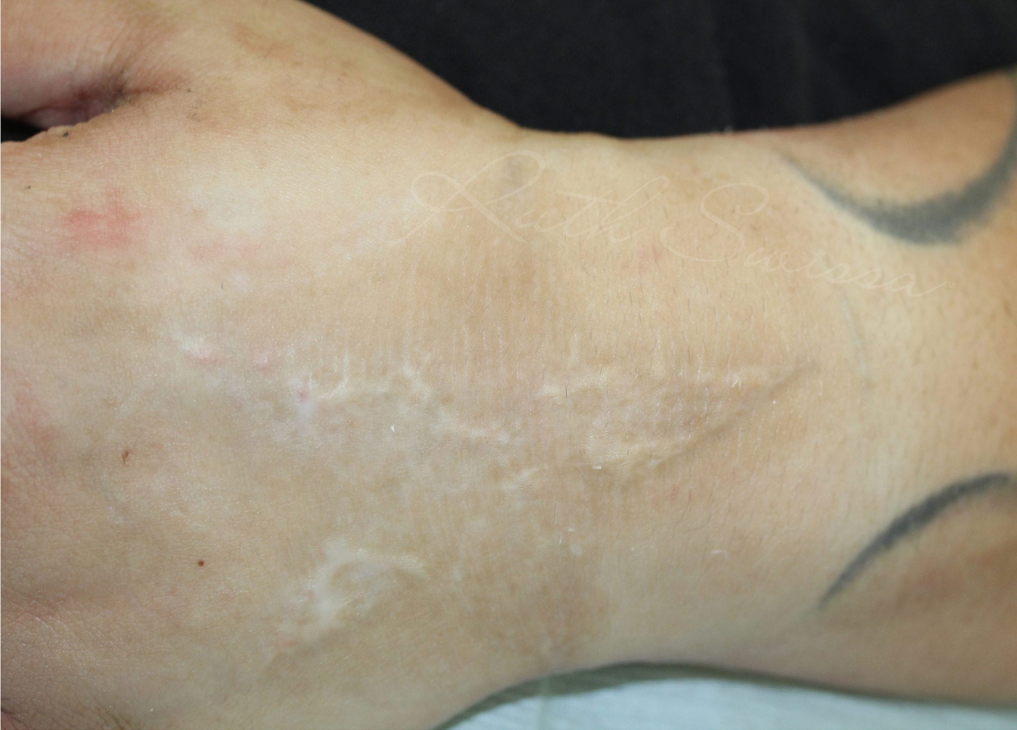 Scar Camouflage Before Treatment Photo