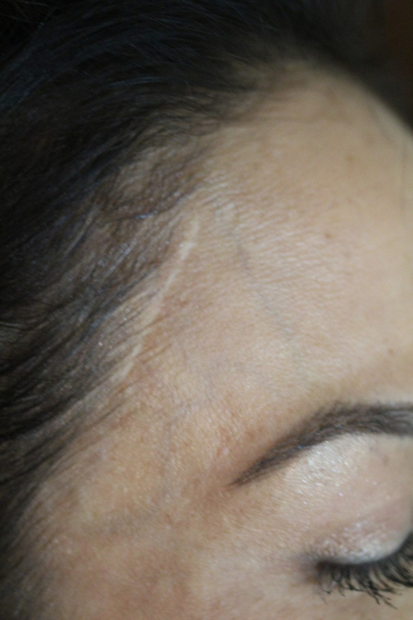 Scar Camouflage Before Treatment Image