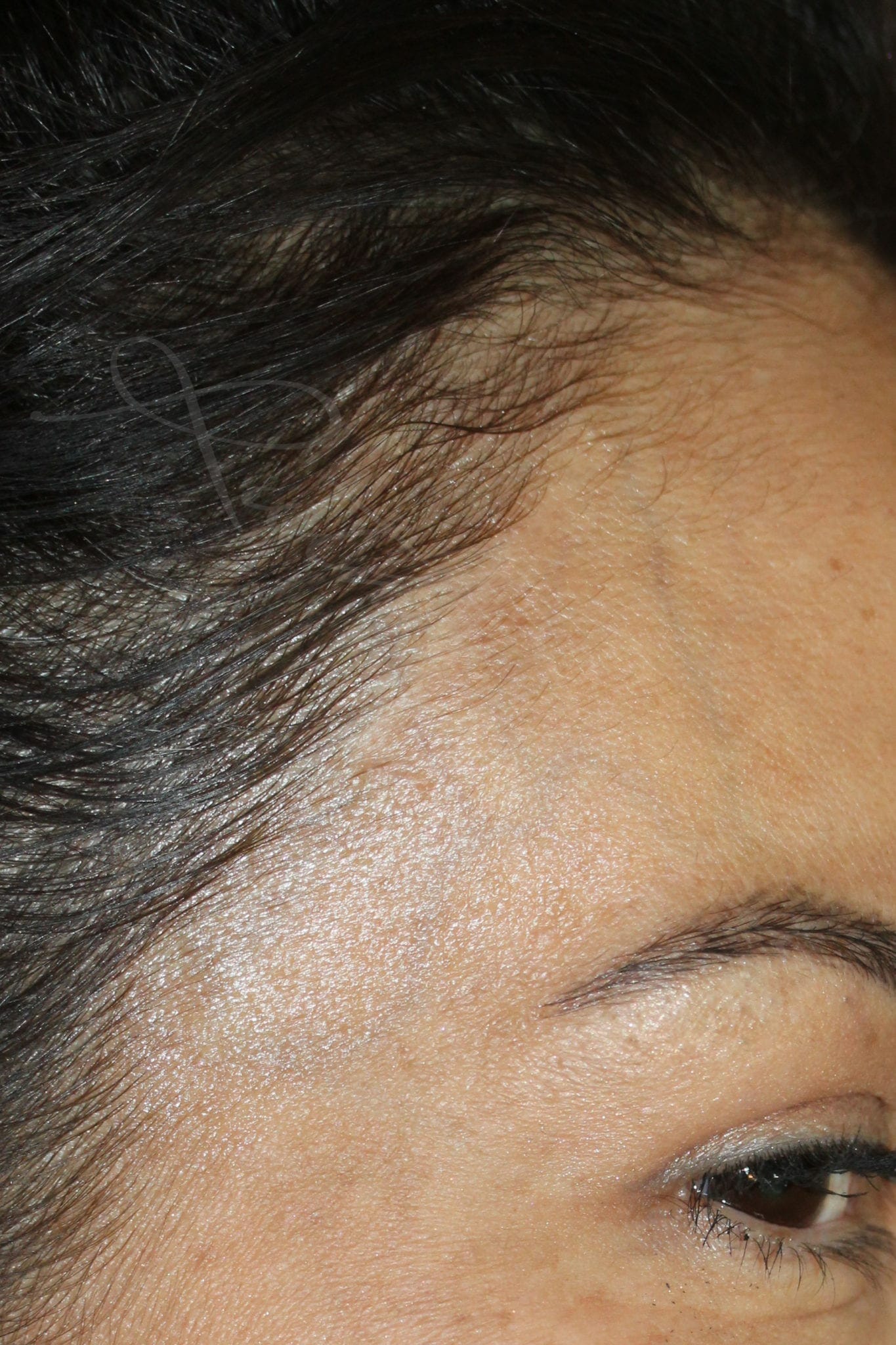Scar Camouflage After Treatment