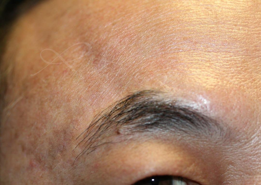 Eyebrows Scar Camouflage Photo