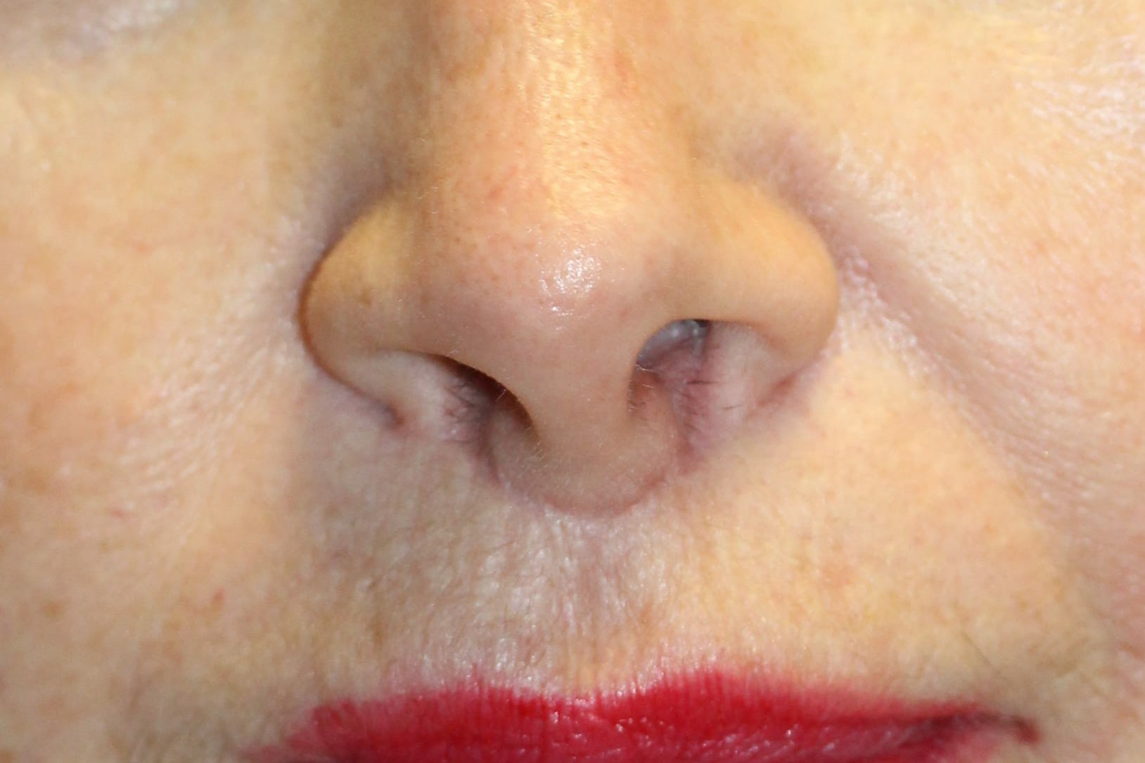 Scar Camouflage After Treatment