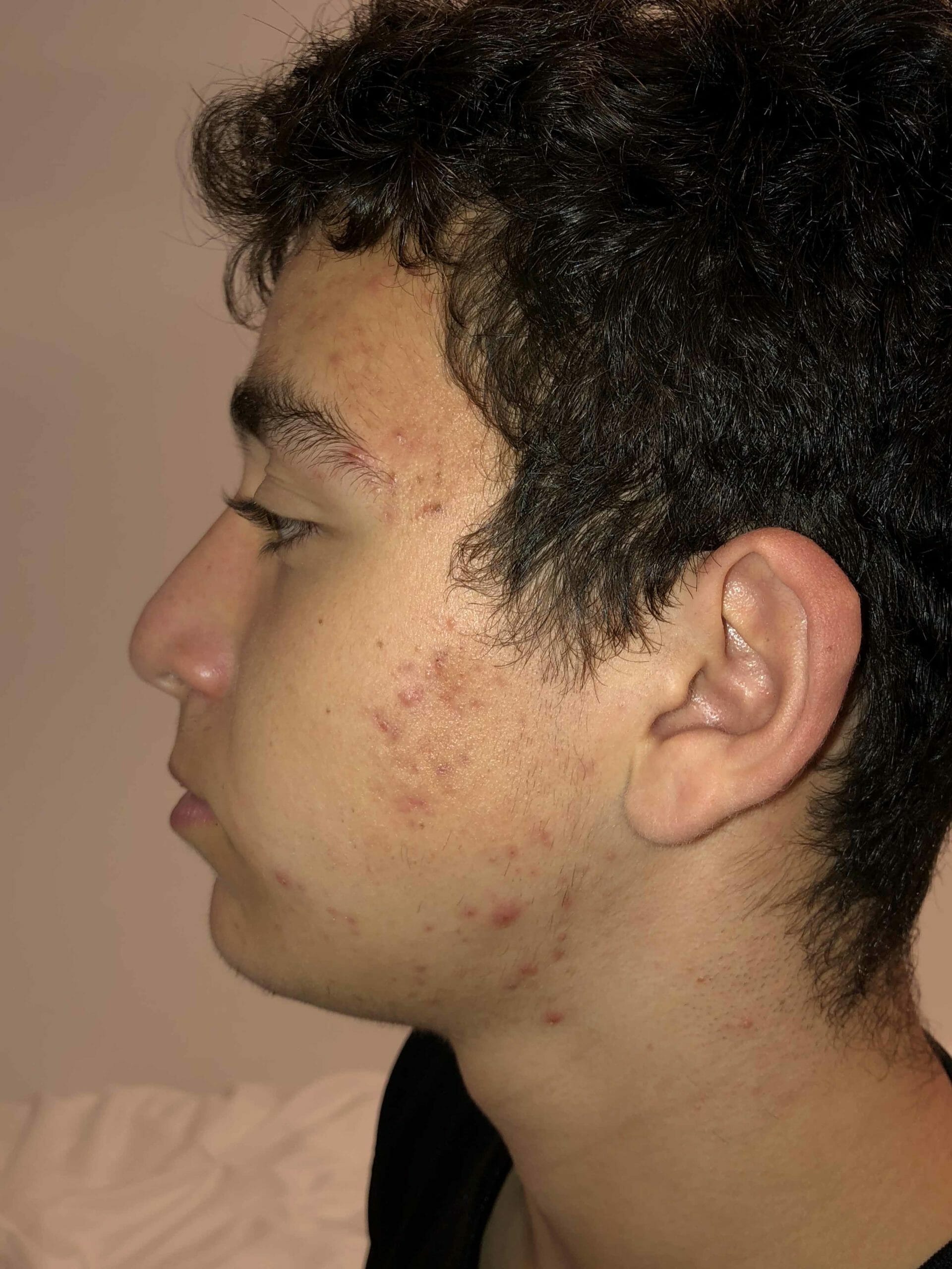 Before Acne Treatment Picture