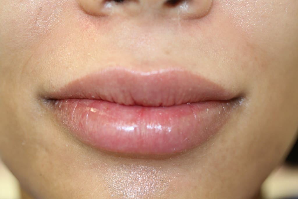 Permanent Lip Liner Color After Treatment Image