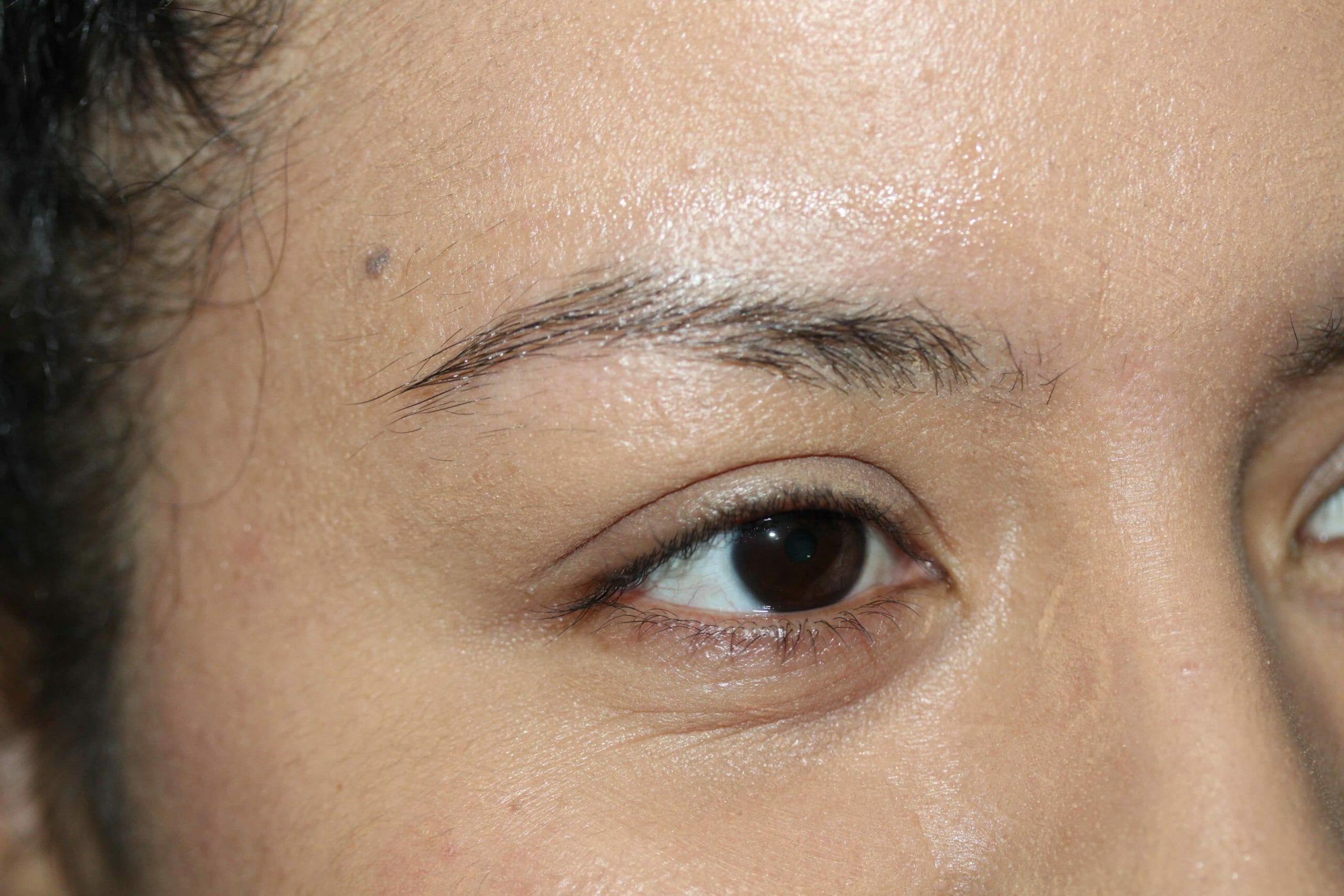 Before Image Eyebrow Angle Scaled