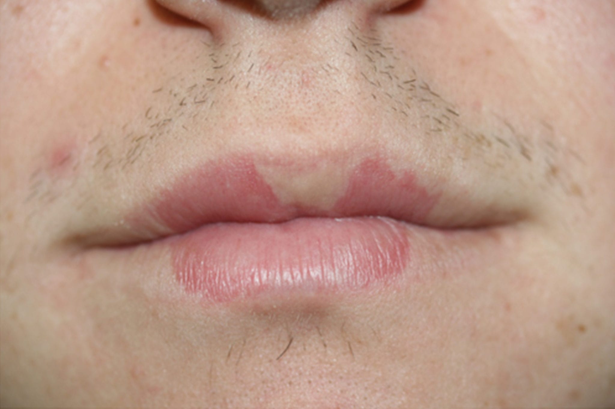 Lip-discoloration