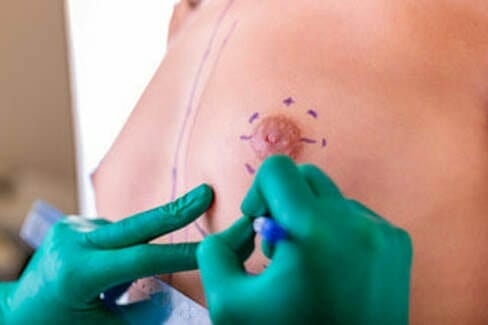 areola pigmentation