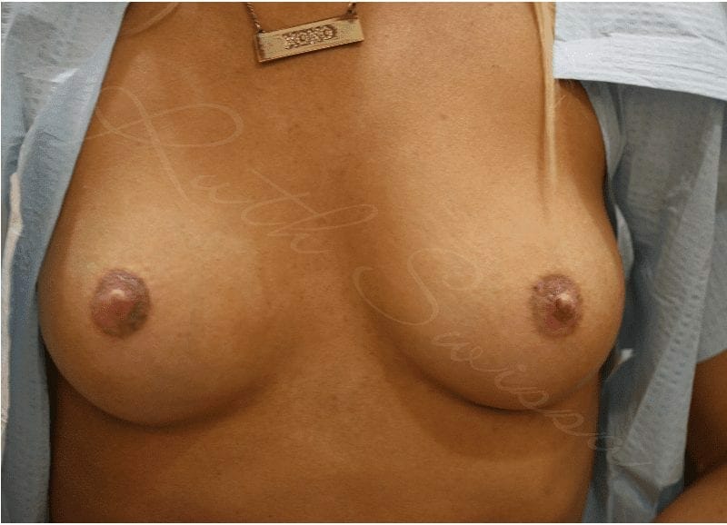Breast Augmentation Image