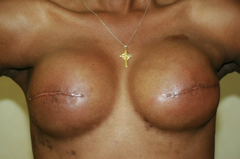 Breast Cancer Picture