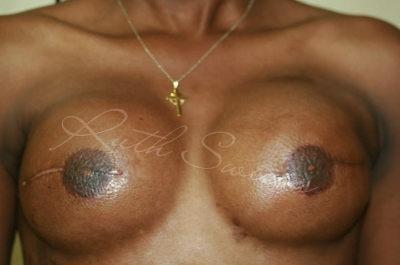 Breast Cancer After Treatment Picture