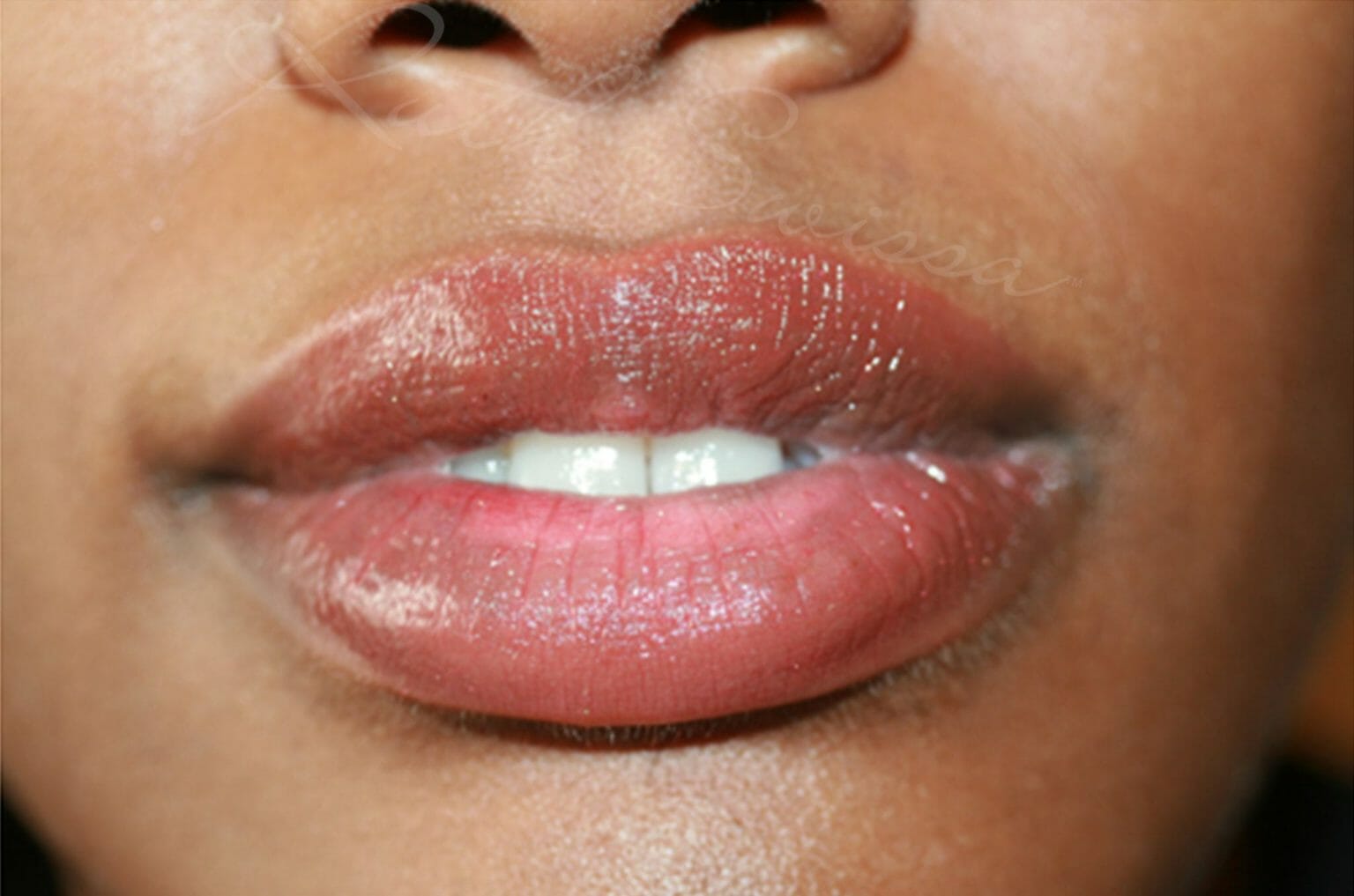 Permanent Lip liner Before and After Photos