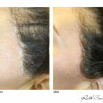 microneedling