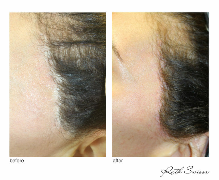 microneedling