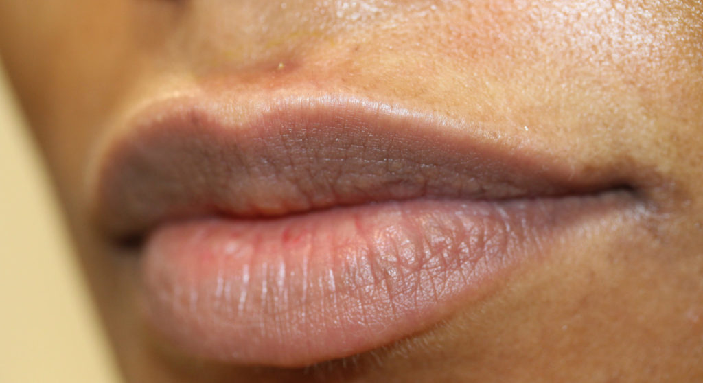 Lips 5 before