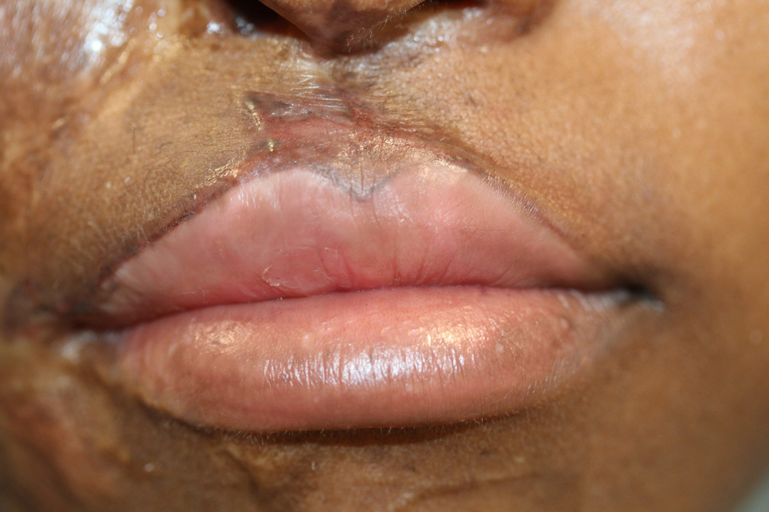 Lips 9 after permanent lip makeup