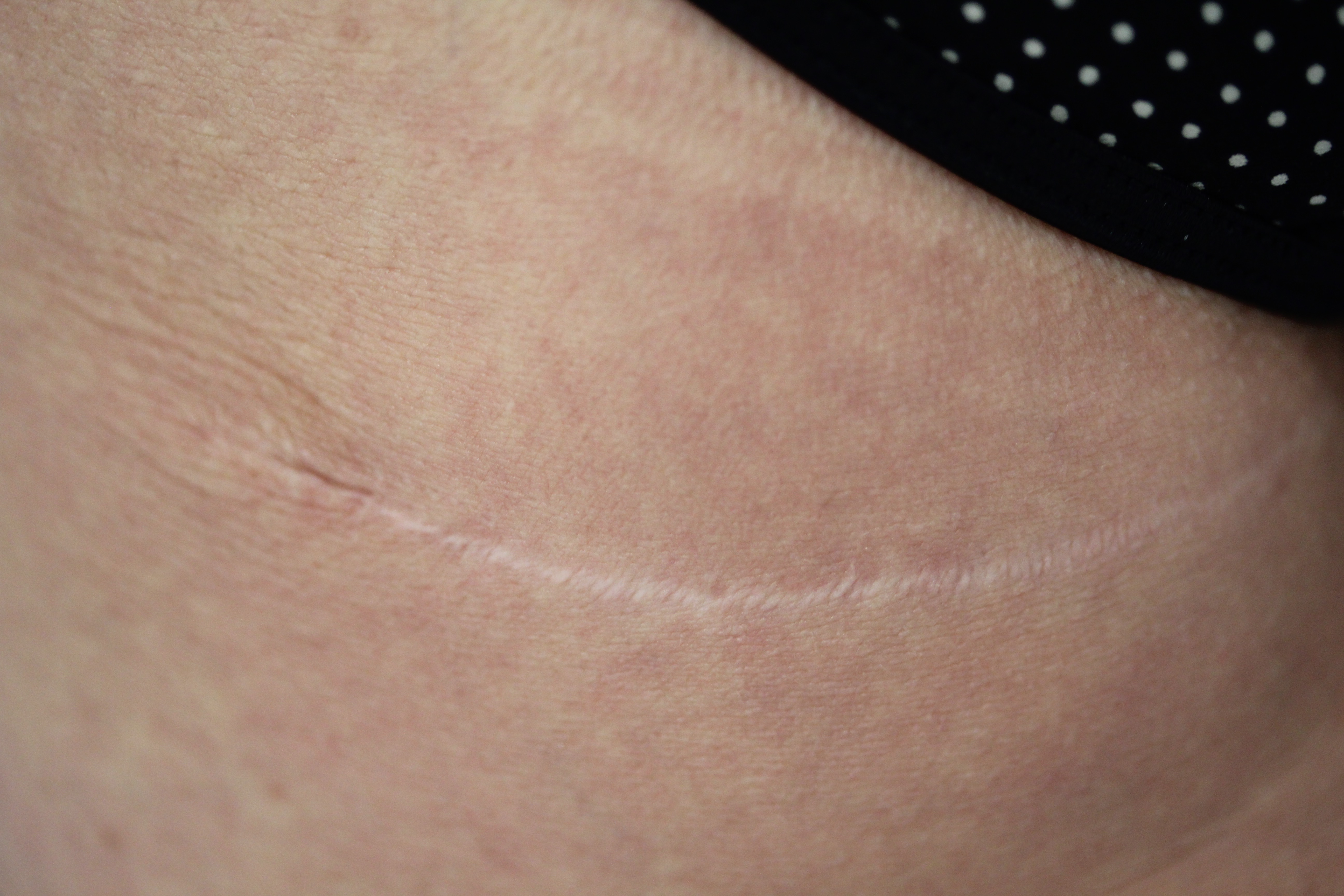 Permanent Makeup Scar Camouflage at Ruth Swissa Med Spa