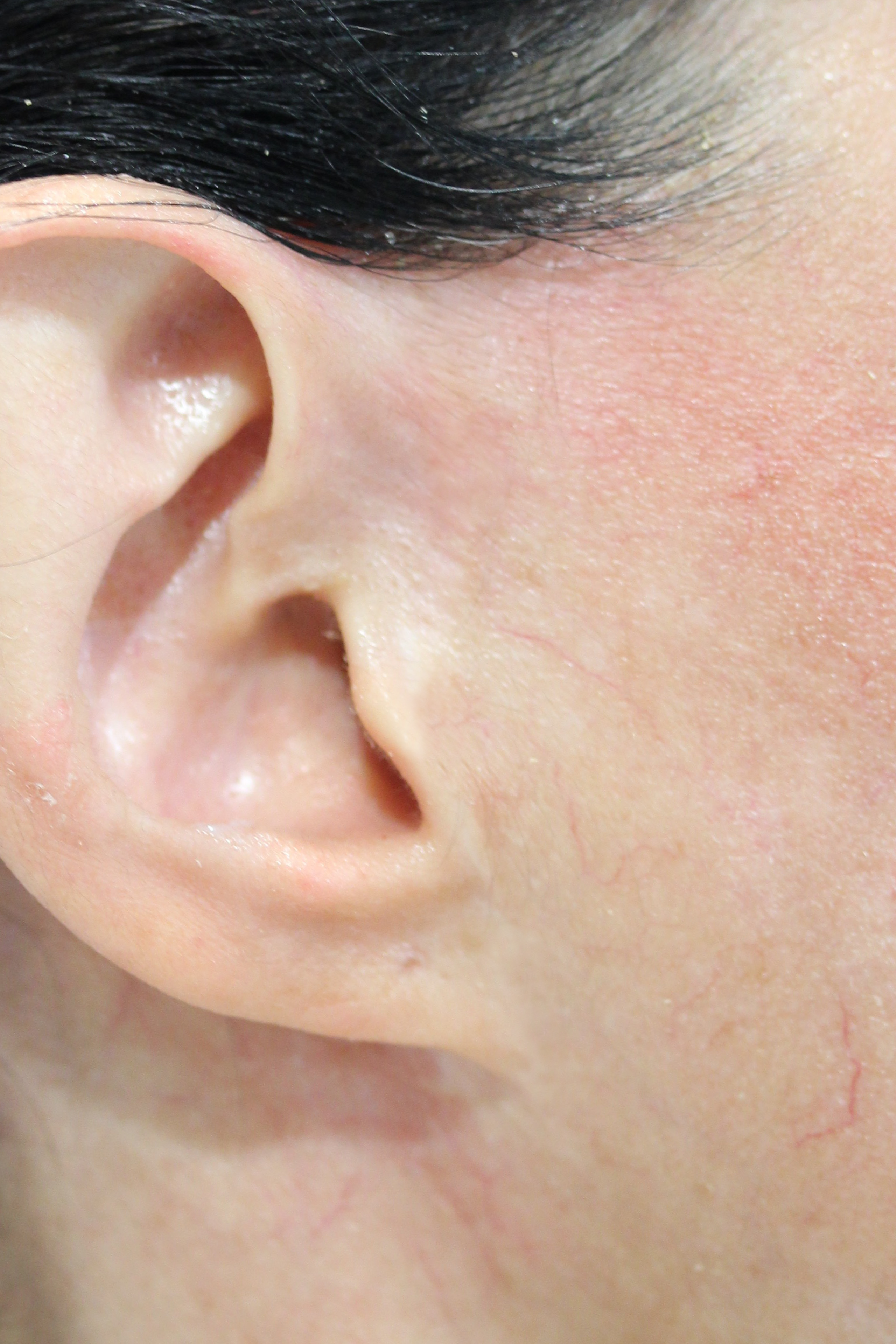 Scar Camouflage Permanent Makeup at Ruth Swissa