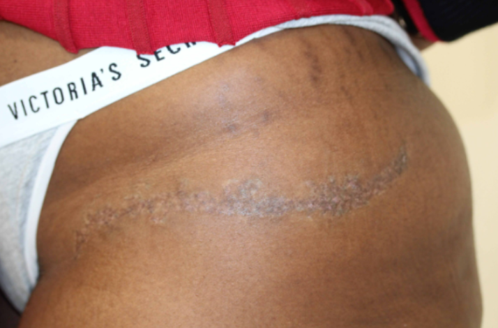 after the burn after the burn