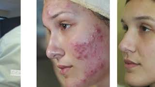Bee Venom And Live Snail Facial On LA Unscripted Ruth Swissa Thumbnail