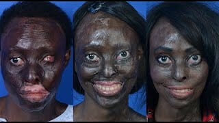 Permanent Makeup Los Angeles Burn Victim Scar Camouflage Thumbnail