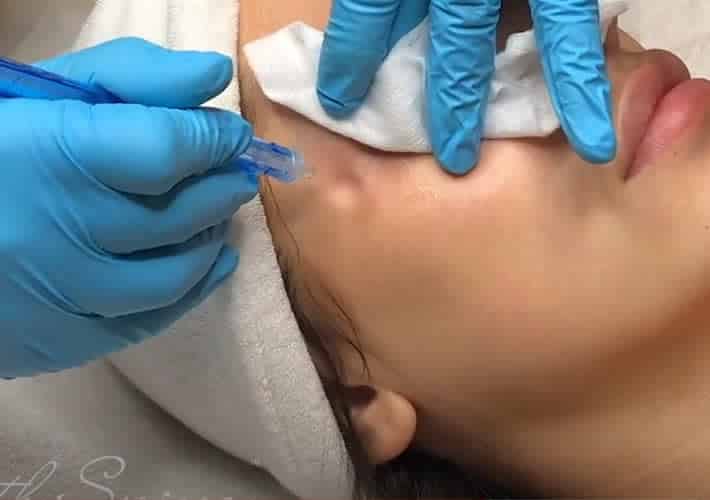 11 No Needle Fillers With JetPeel Facial On Morgan B Cohen