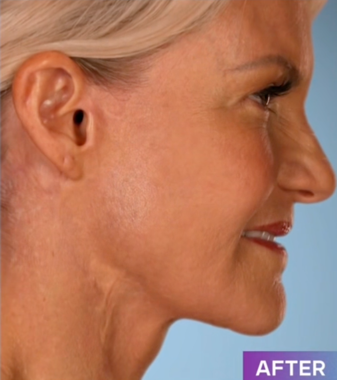Ruth Swissa Scar Camouflage Medical tattooing Facelift Botched