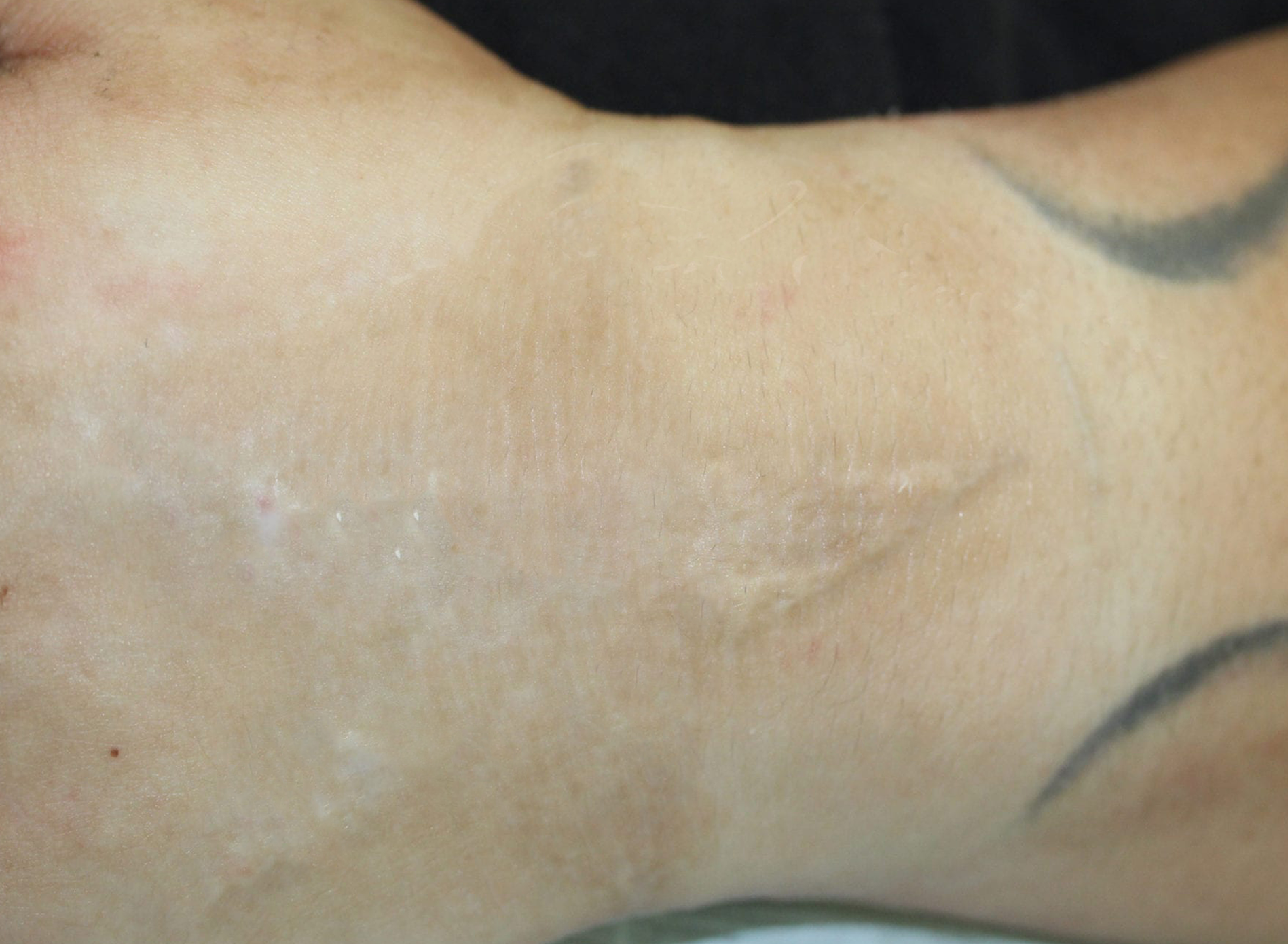 Ruth Swissa Scar Camouflage Medical tattooing Discoloration