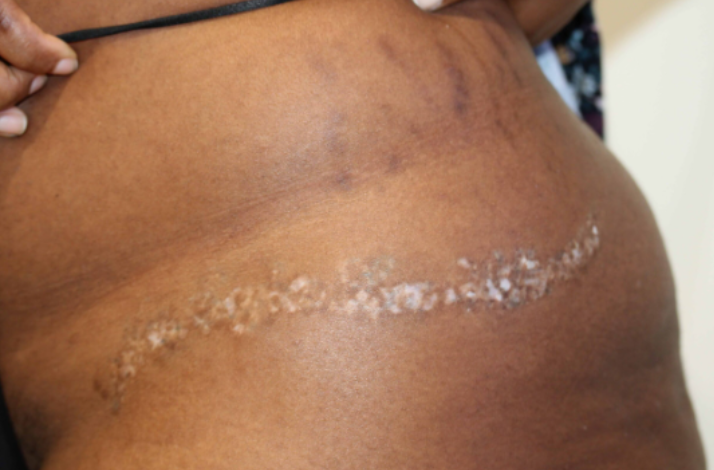 Ruth Swissa Scar Camouflage Medical tattooing burn survivor