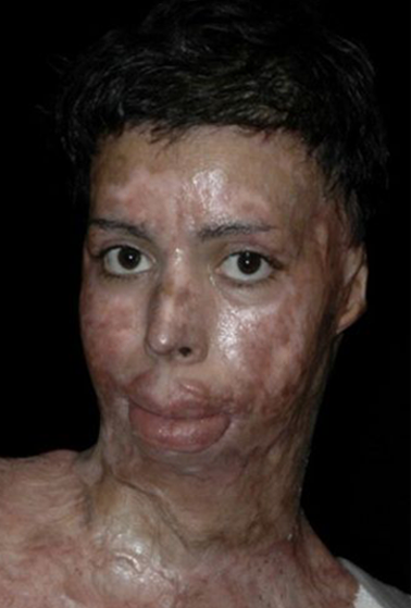 Ruth Swissa Scar Camouflage Medical tattooing burn survivor