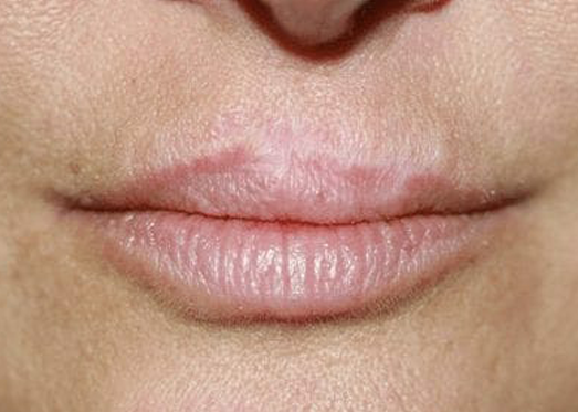 lip blushing permanent lip liner Cleft palet