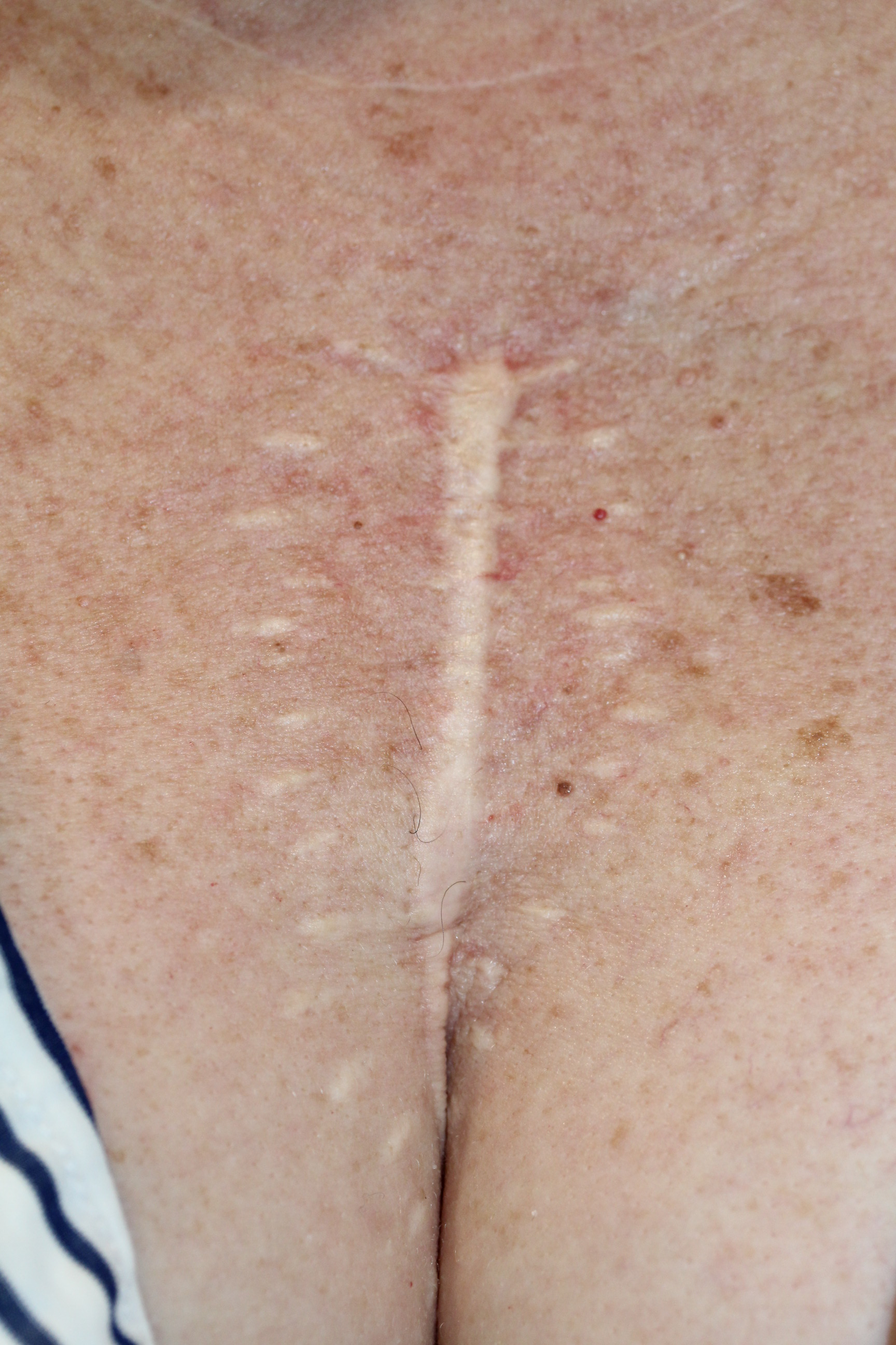 Ruth Swissa Scar Camouflage Medical tattooing Discoloration
